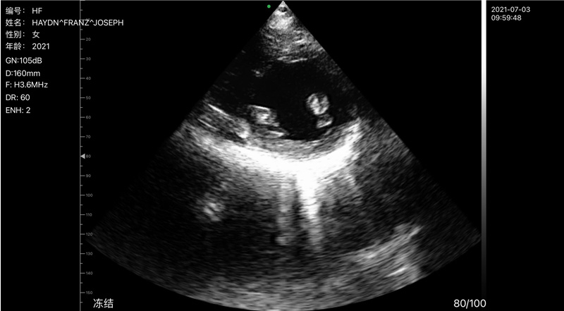 Wireless Ultrasound for Kalp kılcal kas