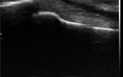 Kavisli doğrusal ultrason probu parmak Flexor Tendon